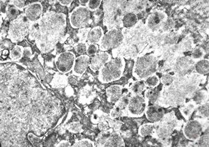 M,39y. | lymph node - metastasis of adenocarcinoma